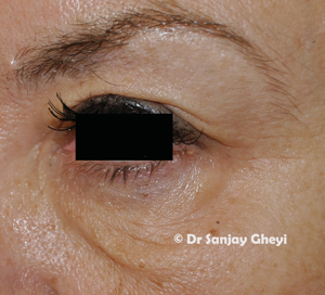 Excess skin on eyelids
